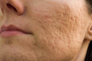 Rolling scarring - dermal filler - London Real Skin