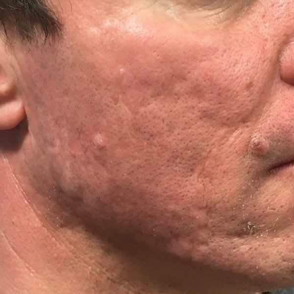 Acne Scar Treatment – After sq Acne Scar Treatment - After sq