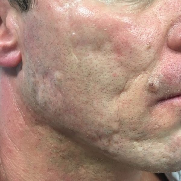 Acne Scars Treatment – Before sq Acne Scars Treatment - Before sq