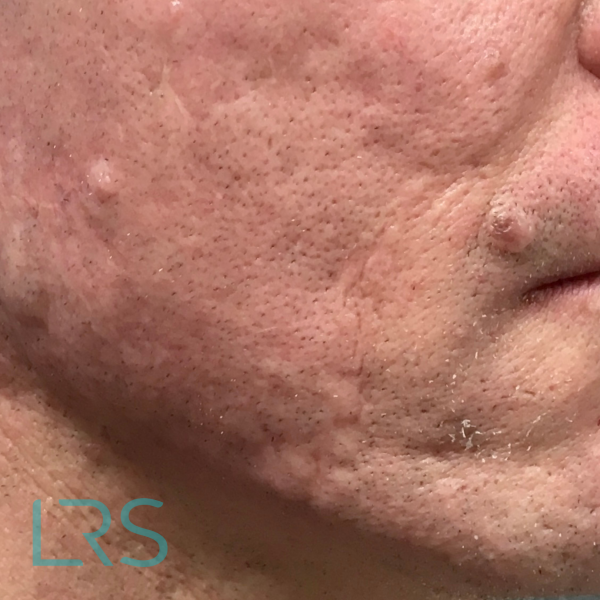 Acne scarring – AFTER ZOOMED Dermal filler results
