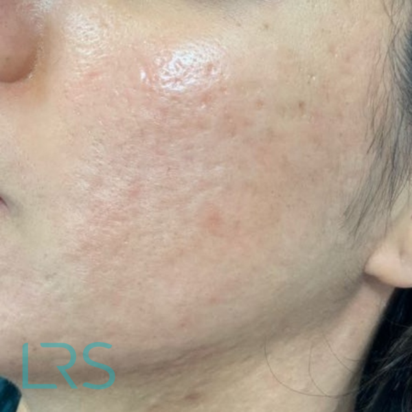 Acne scarring – microneedling – AFTER Micro-needling results