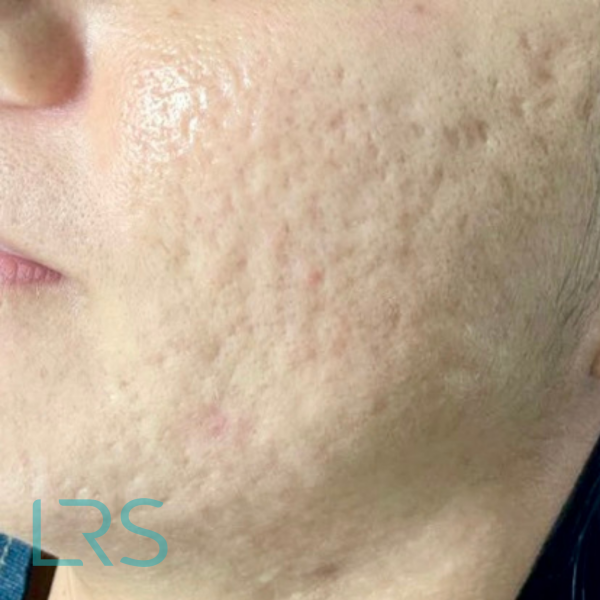 Acne scarring – microneedling – BEFORE Micro-needling results