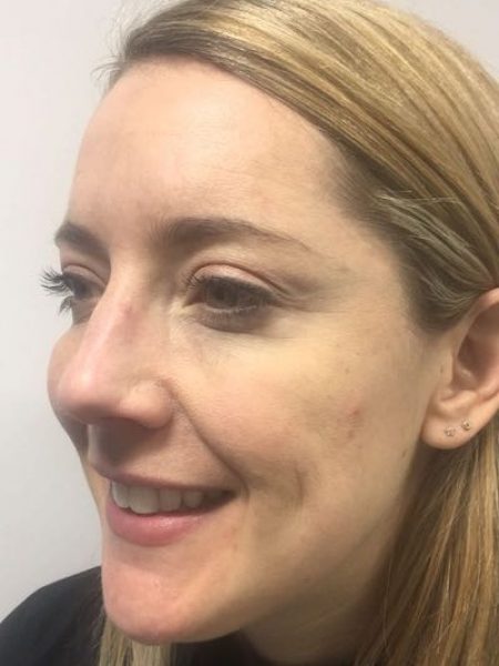 Botox Female – After 400 Botox Female - After 400