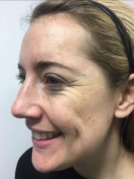 Botox Female – Before 400 Botox Female - Before 400