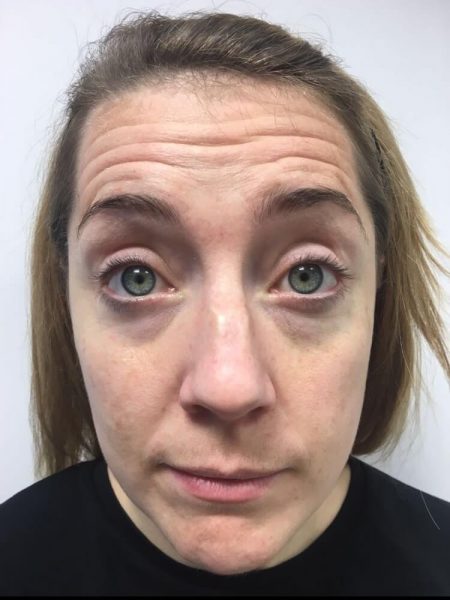 Botox Forehead Before Botox Forehead Before