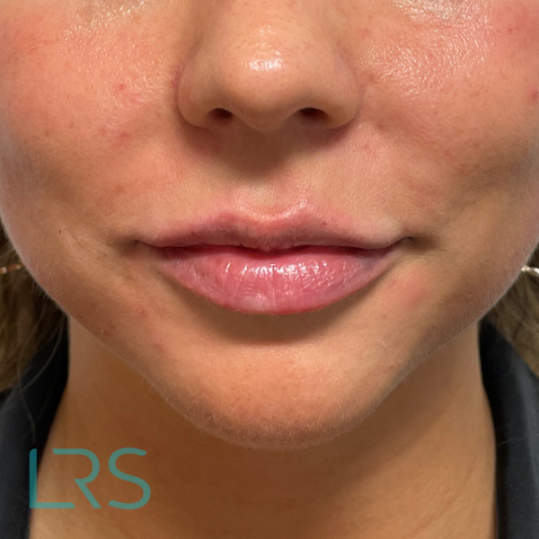 LIP FILLER LONDON REAL SKIN – AFTER LIP FILLER LONDON REAL SKIN - AFTER