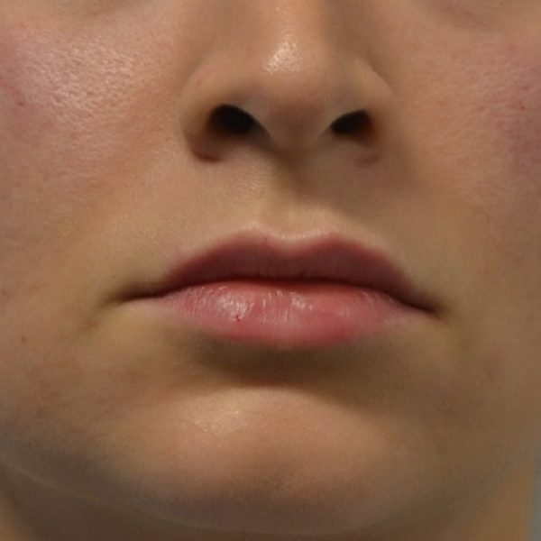 Lips After sq Lips After sq