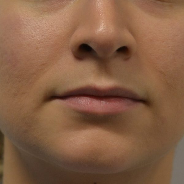 Lips Before sq Lips Before sq