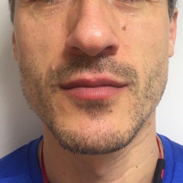 Male Lip Enhancement – After sq Male Lip Enhancement - After sq