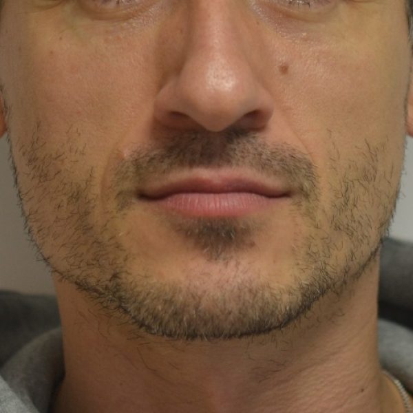 Male Lip Enhancement – Before sq Male Lip Enhancement - Before sq