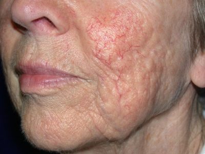 Thread Veins Face – Before crop Thread Veins Face - Before crop