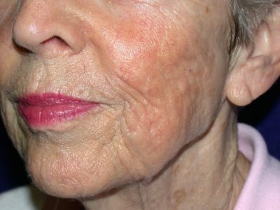 Thread Veins Face – aft crop Thread Veins Face - aft crop