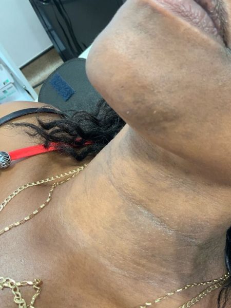 hair removal after 68 hair removal after 68