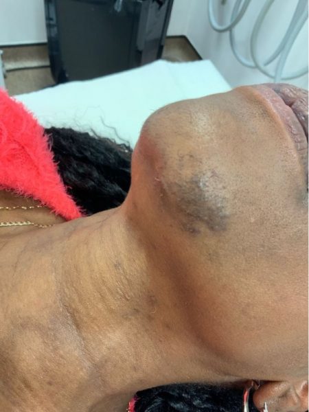 hair removal b4 68 hair removal b4 68