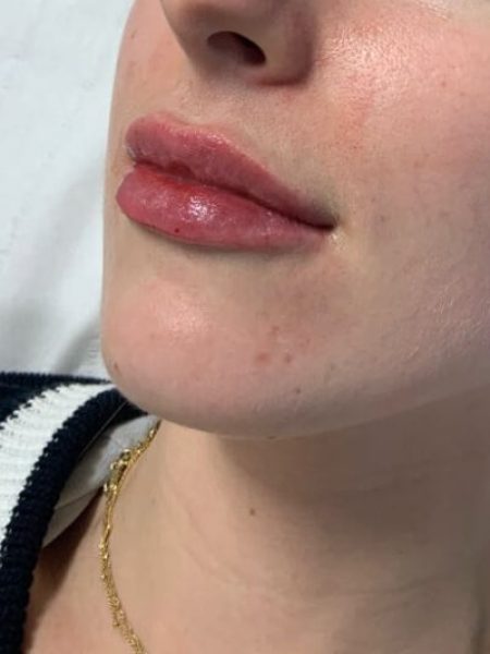 lip filler after (1)