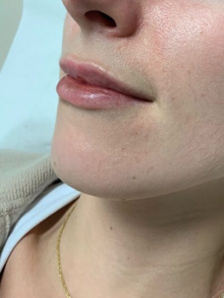 lip filler before (1) lip filler before (1)