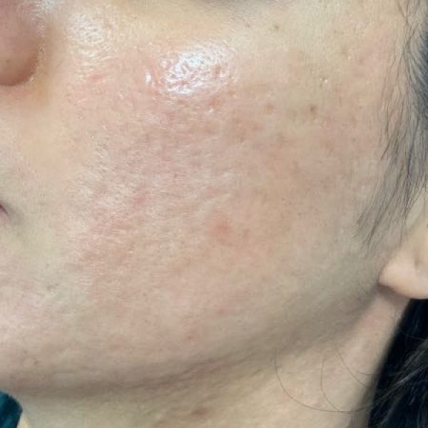 microneedling acne after