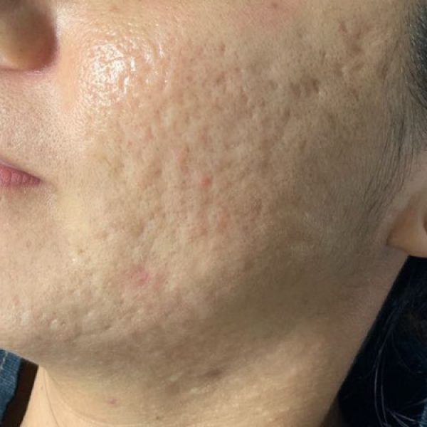 microneedling acne before microneedling acne before