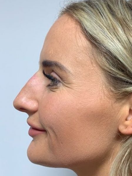 rhinoplasty after 43 rhinoplasty after 43